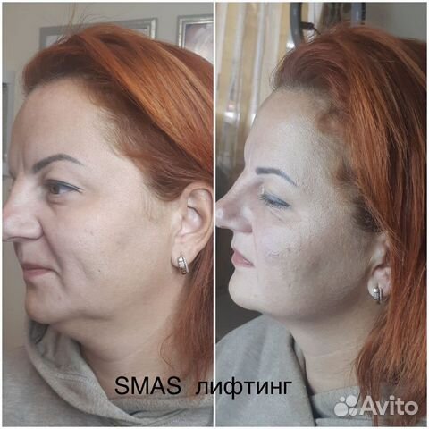 Аппаратная мезотерапия
