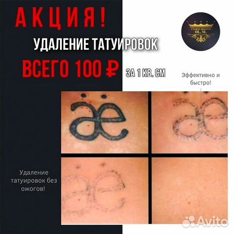 Удаление Татуировок Татуажа