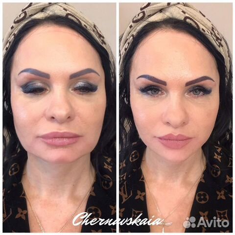 Лифтинговая процедура Фул фэйс Лифтинговая процедура Фул фэйс